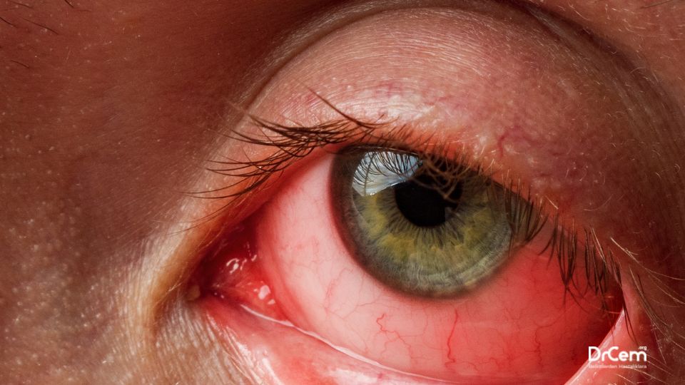 Viral Konjuktivit görseli - DrCem hastalık rehberi